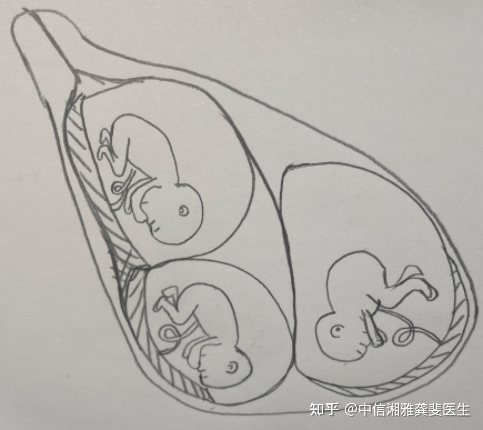 图17～11 内、外胚层的形成-功能组织学与胚胎学-医学