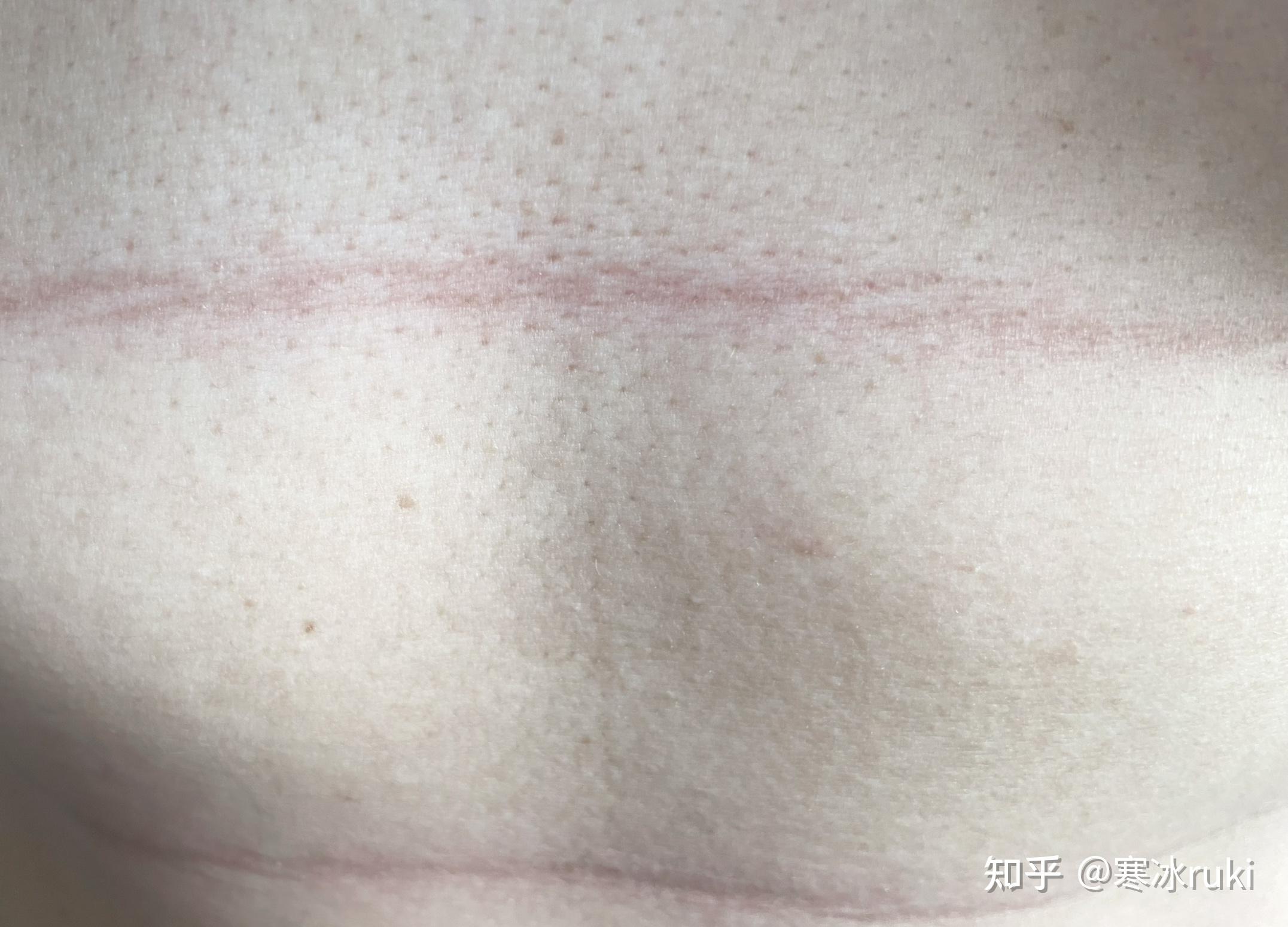 肚子上有很深的横纹,像勒出来的那种怎么去除? - 知乎