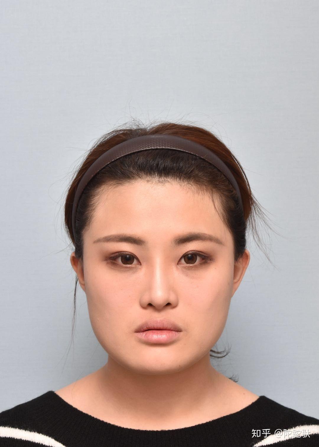 韩国faceline菲斯莱茵整形医院中国官网-韩国双鄂手术，面部轮廓整形，面部轮廓修复，面部轮廓医院