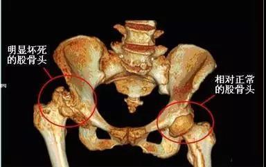 股骨头坏死的5个早期症状 很多人都以为是 关节炎 知乎