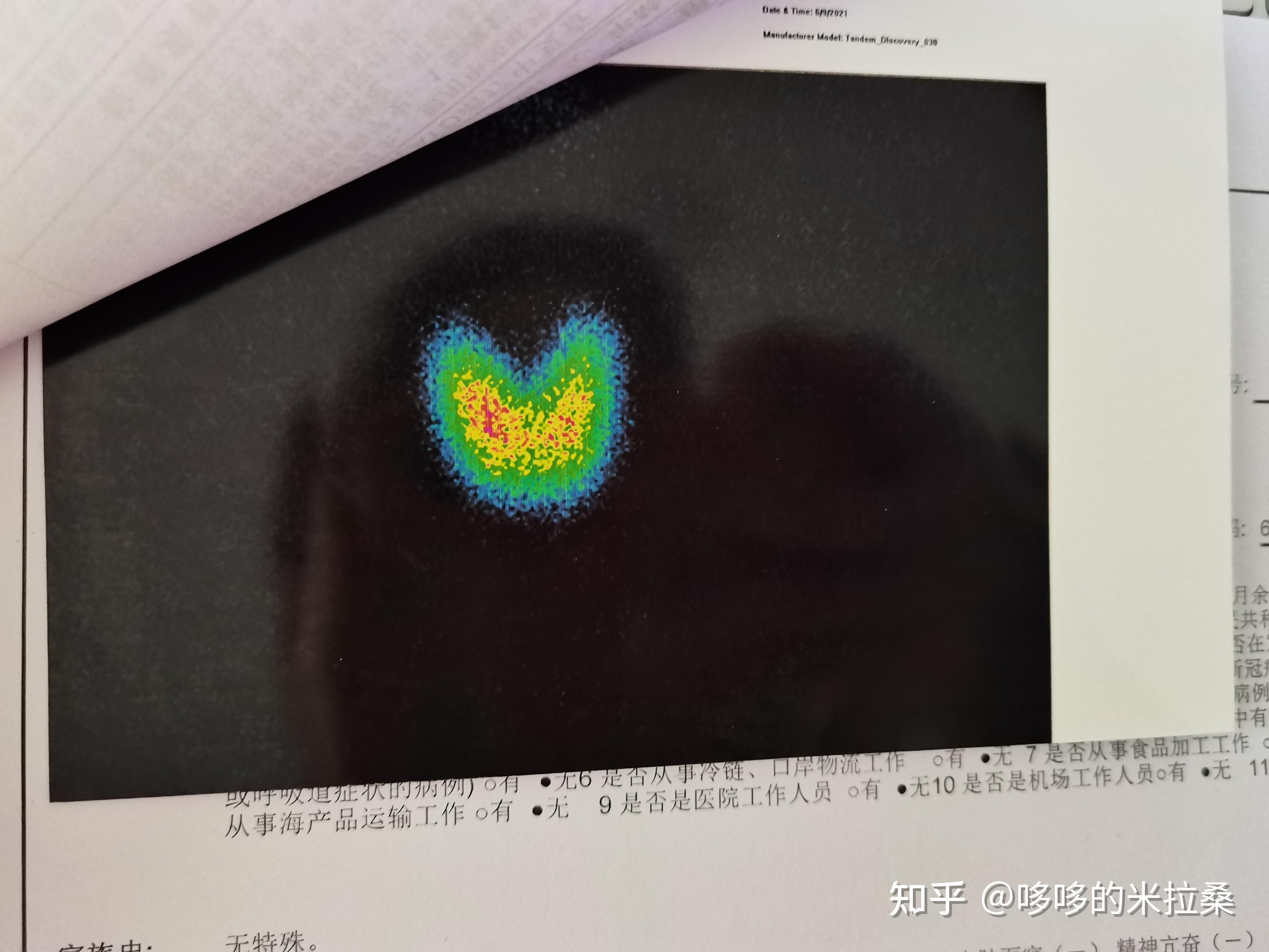 甲亢半年-我做了碘131 - 知乎