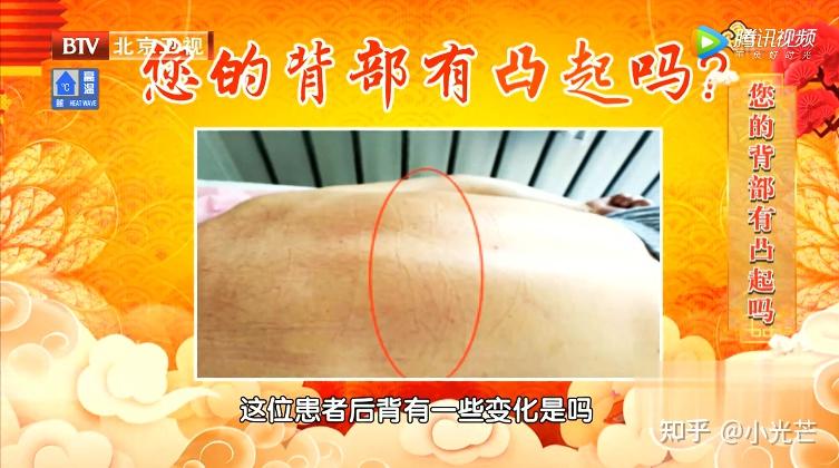 肩膀后背骨头凸起来是怎么回事? - 知乎