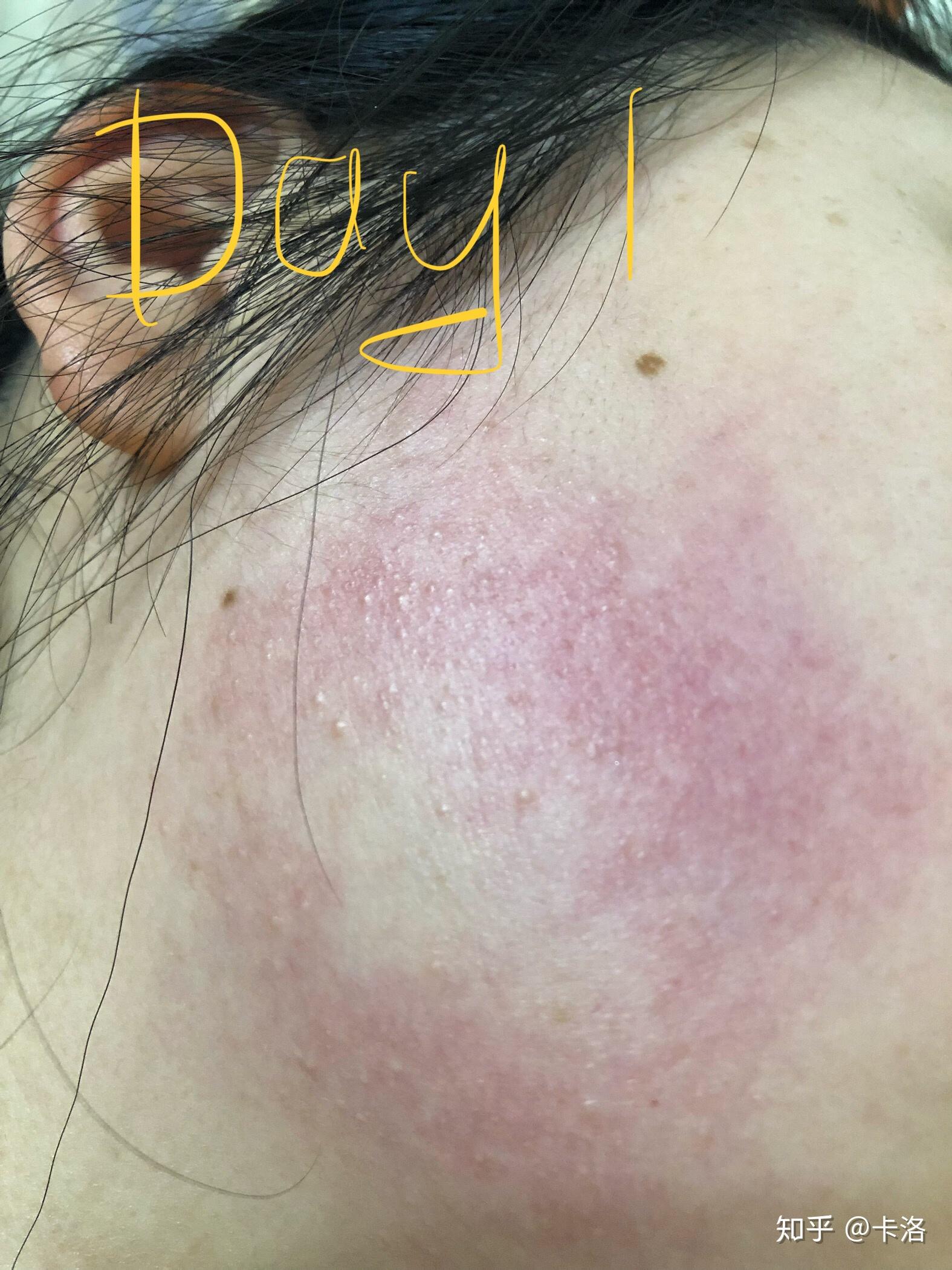 毛囊角质化鸡皮肤是否无法改善