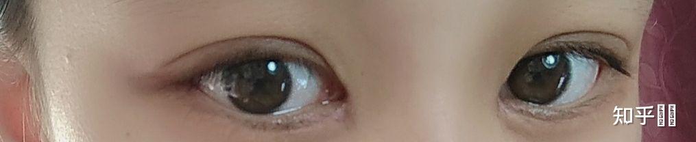 做完下睫毛倒睫手术要大概多久才能恢复原来的样子?