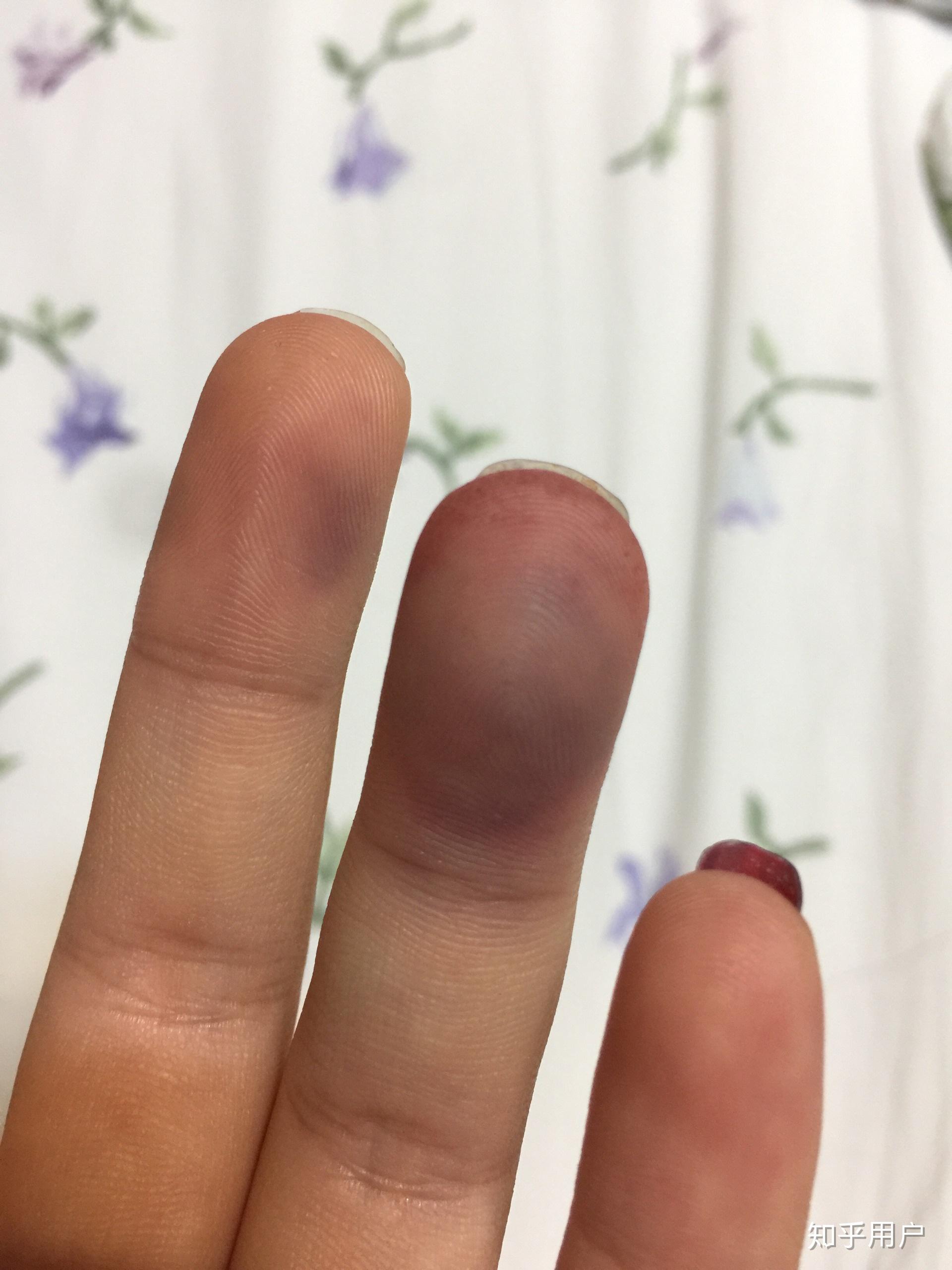 手指被门夹到飙泪是种怎样的体验