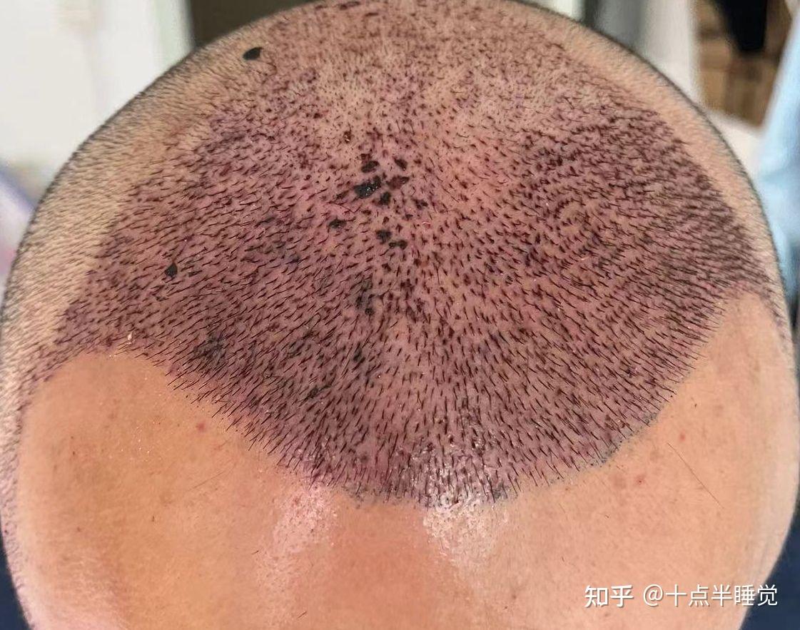 我的植发经历 - 知乎