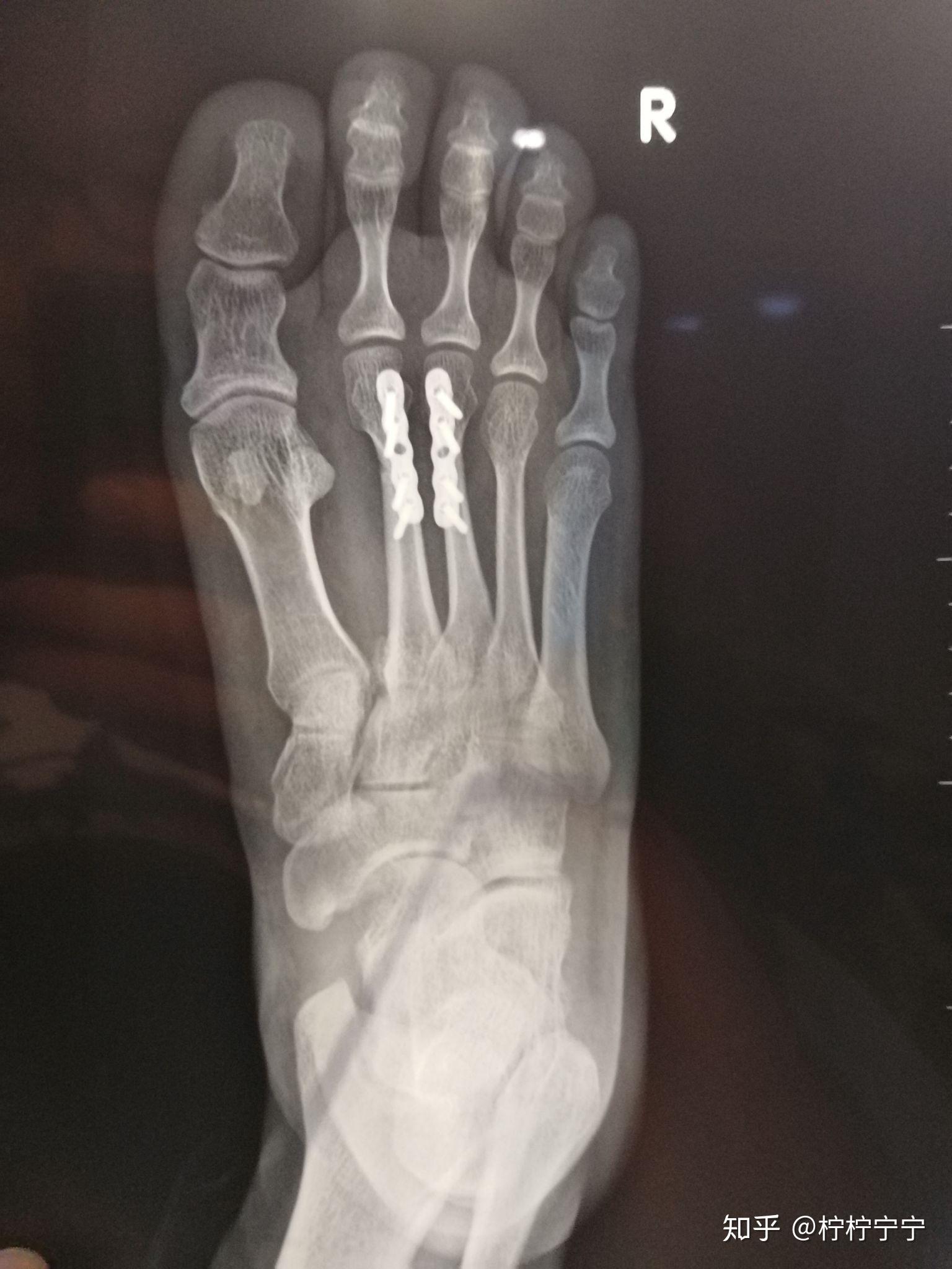 左脚第二跖骨骨折需要多久才能正常走路? - 知乎