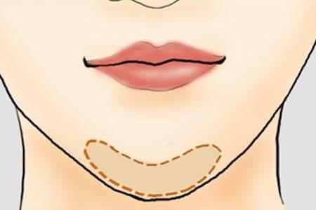 适合颏部严重后缩的患者,填充或者垫下巴不能根本解决问题.