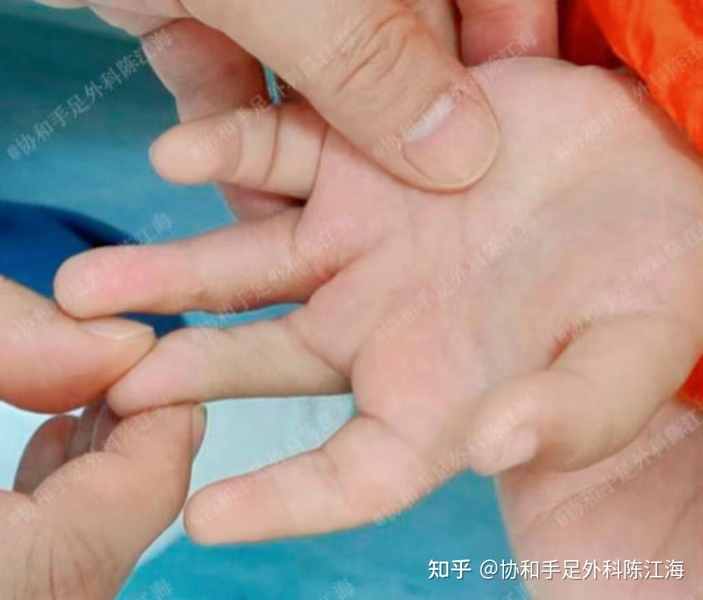 男孩左手天生四指,多年来四处求医终还五指,多亏妈妈的坚持! - 知乎
