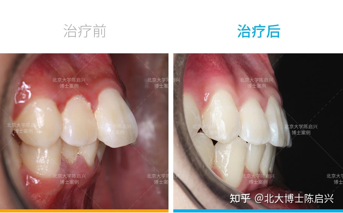腺样体面容兔牙深覆盖矫正案例