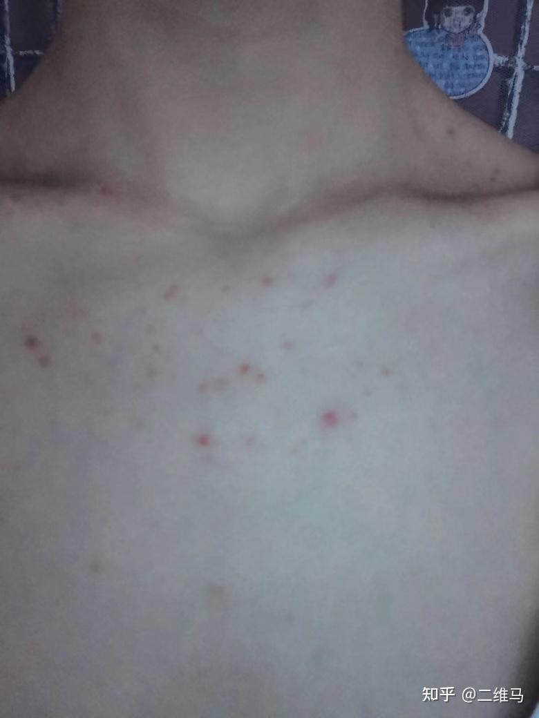 胸前长这样的痘痘而且越来越严重是怎么回事啊怎么解决