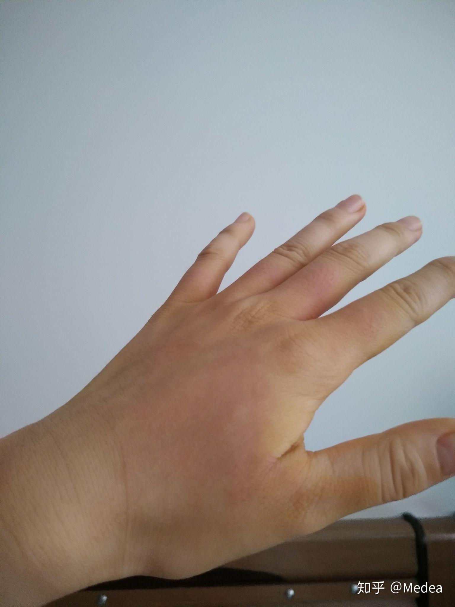 手被开水烫伤了怎么办? - 知乎