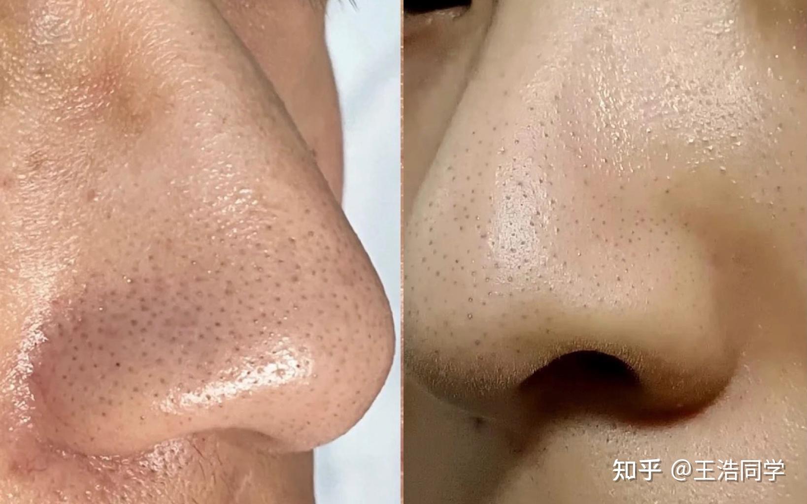 第2步:霍霍巴油软化松动黑头