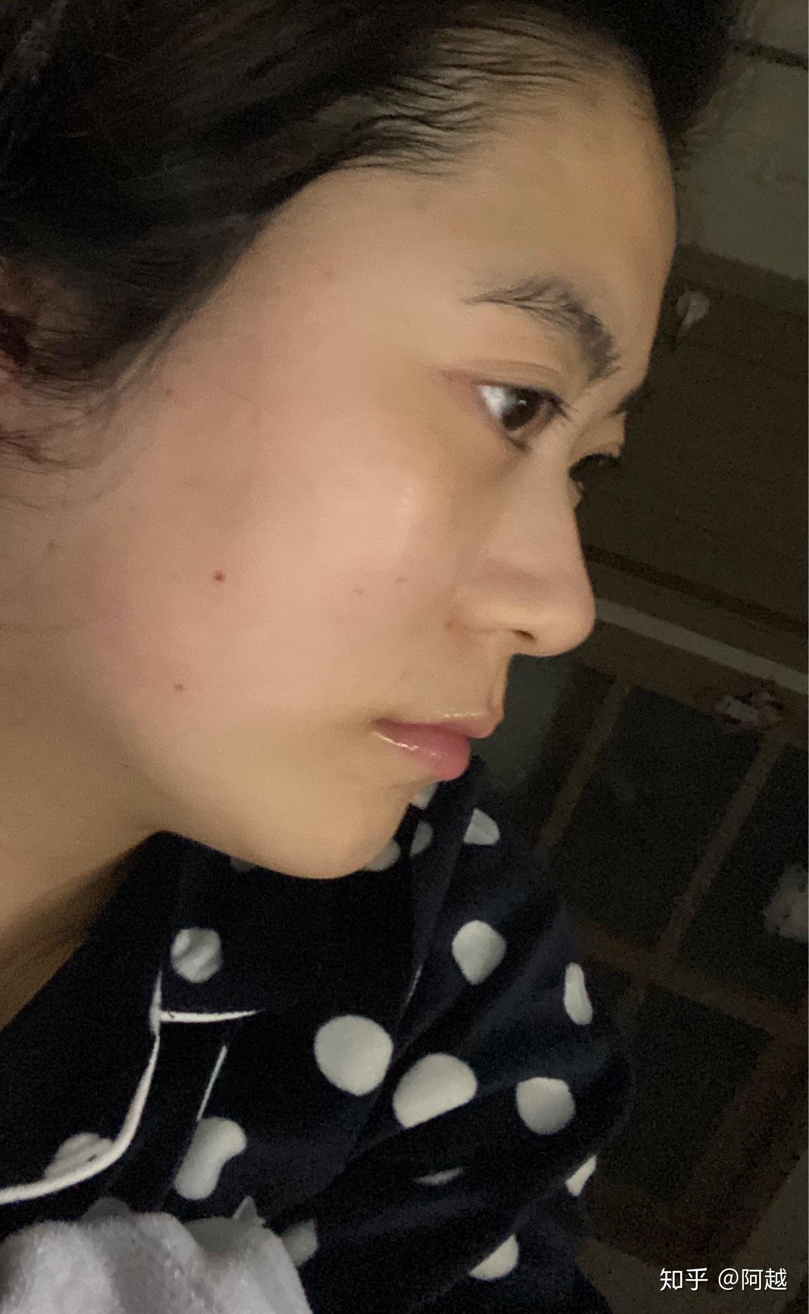 侧面看眼睛非常突,眉骨低和鼻子连接不起来是怎么回事? - 知乎