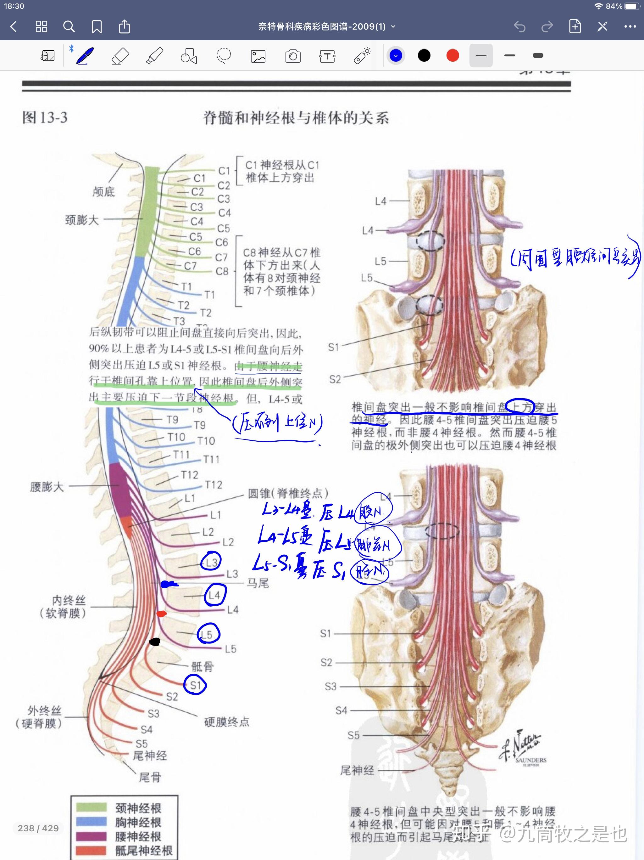 腰三到腰四之间的椎间盘突出