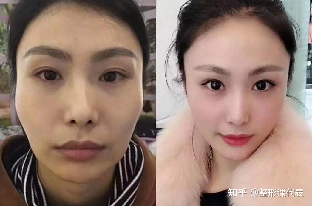 婴儿针前后效果图图片