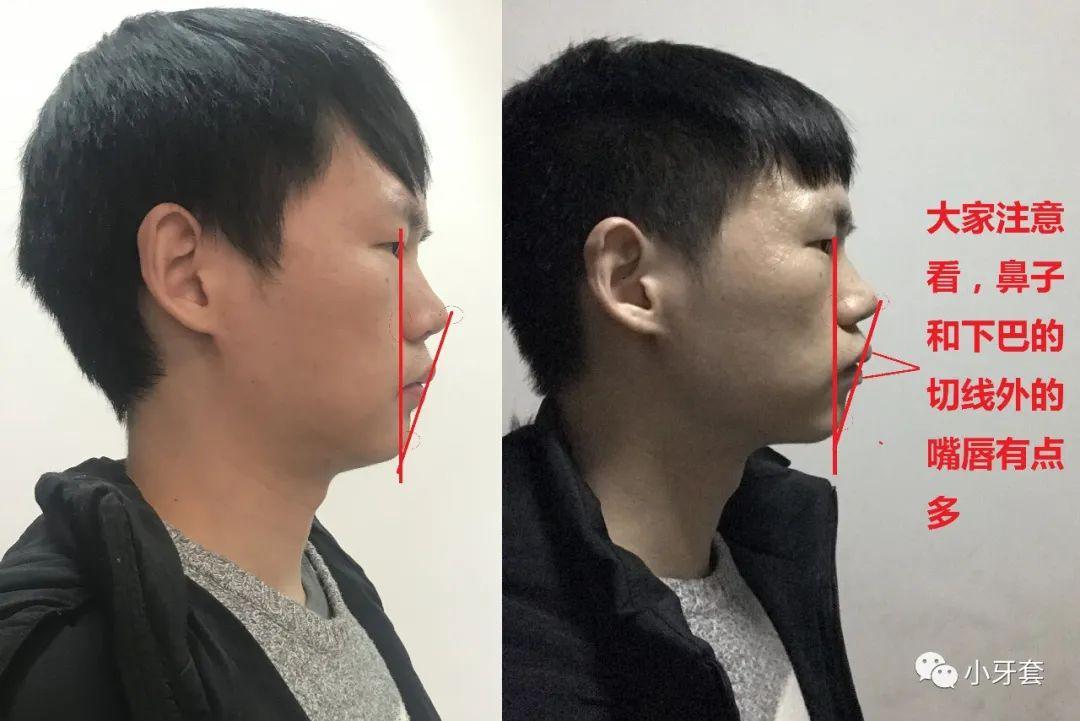 改善下巴后缩嘴凸的口周肌肉锻炼动作带练习视频