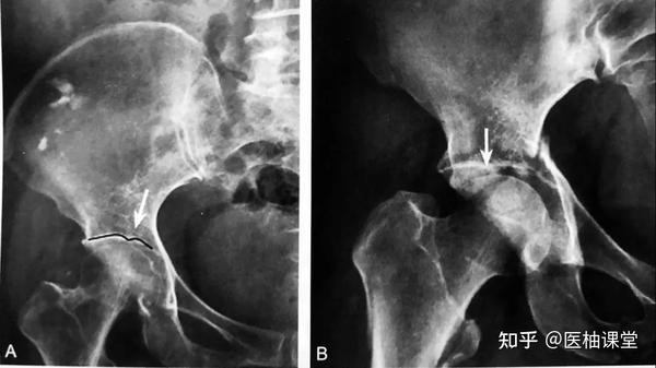 20个常见骨关节影像征象，你认识几个？ - 知乎