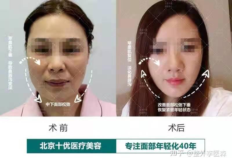 法令纹很严重该如何改善? - 知乎