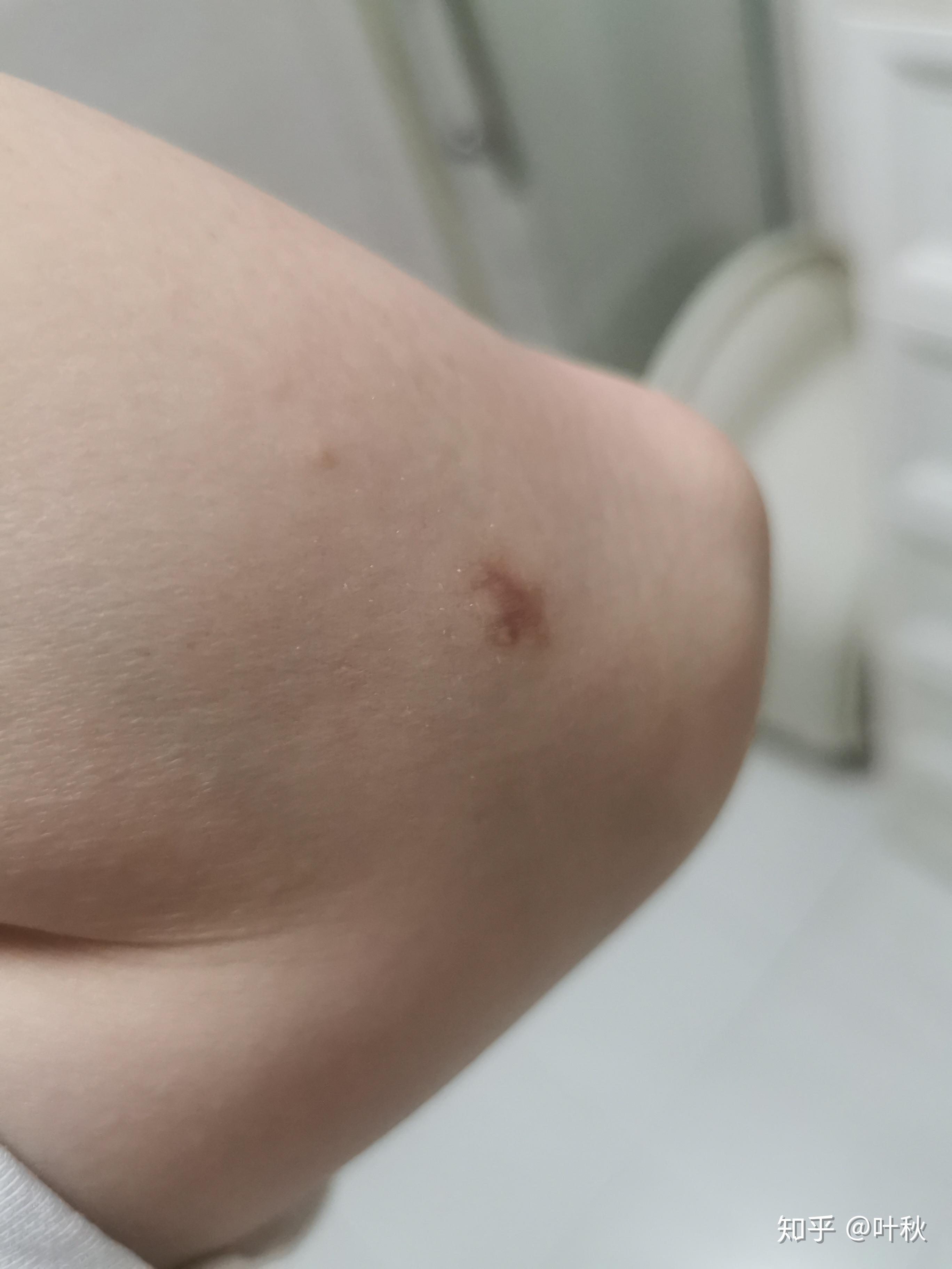 脂肪瘤术后万再一次分享