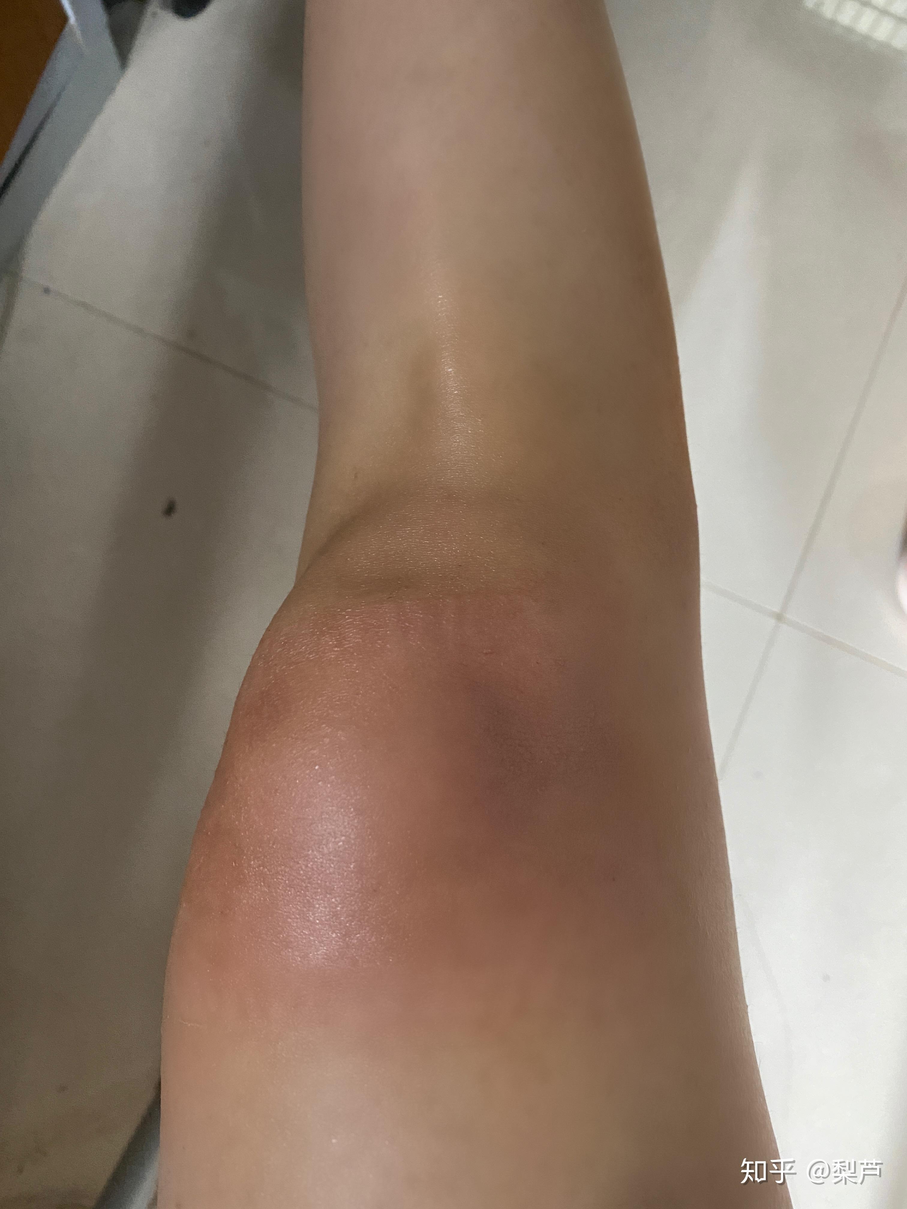 贴膏药过敏怎么办? - 知乎