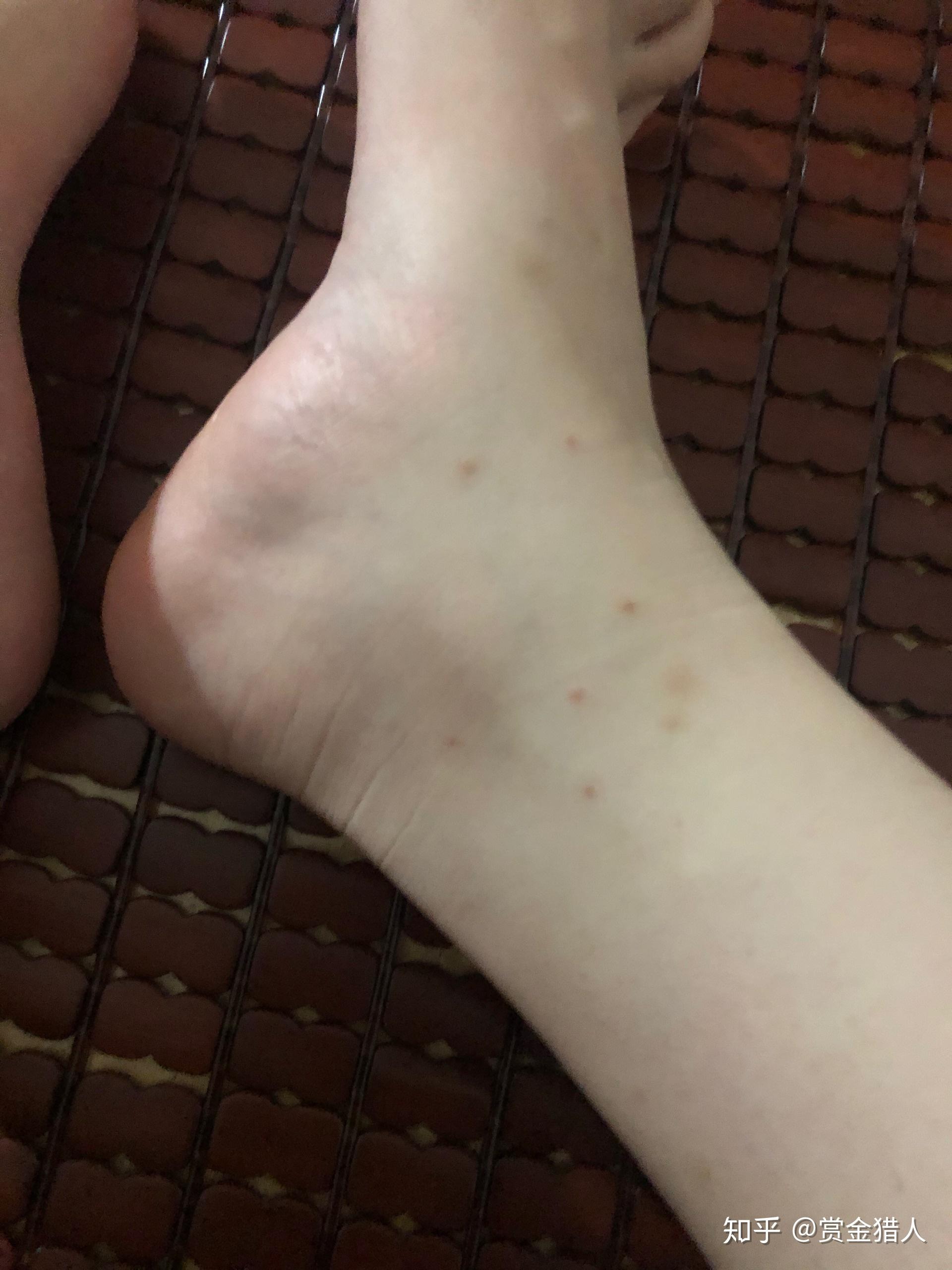 被跳蚤咬的全身都是包是什么样的感受! - 知乎