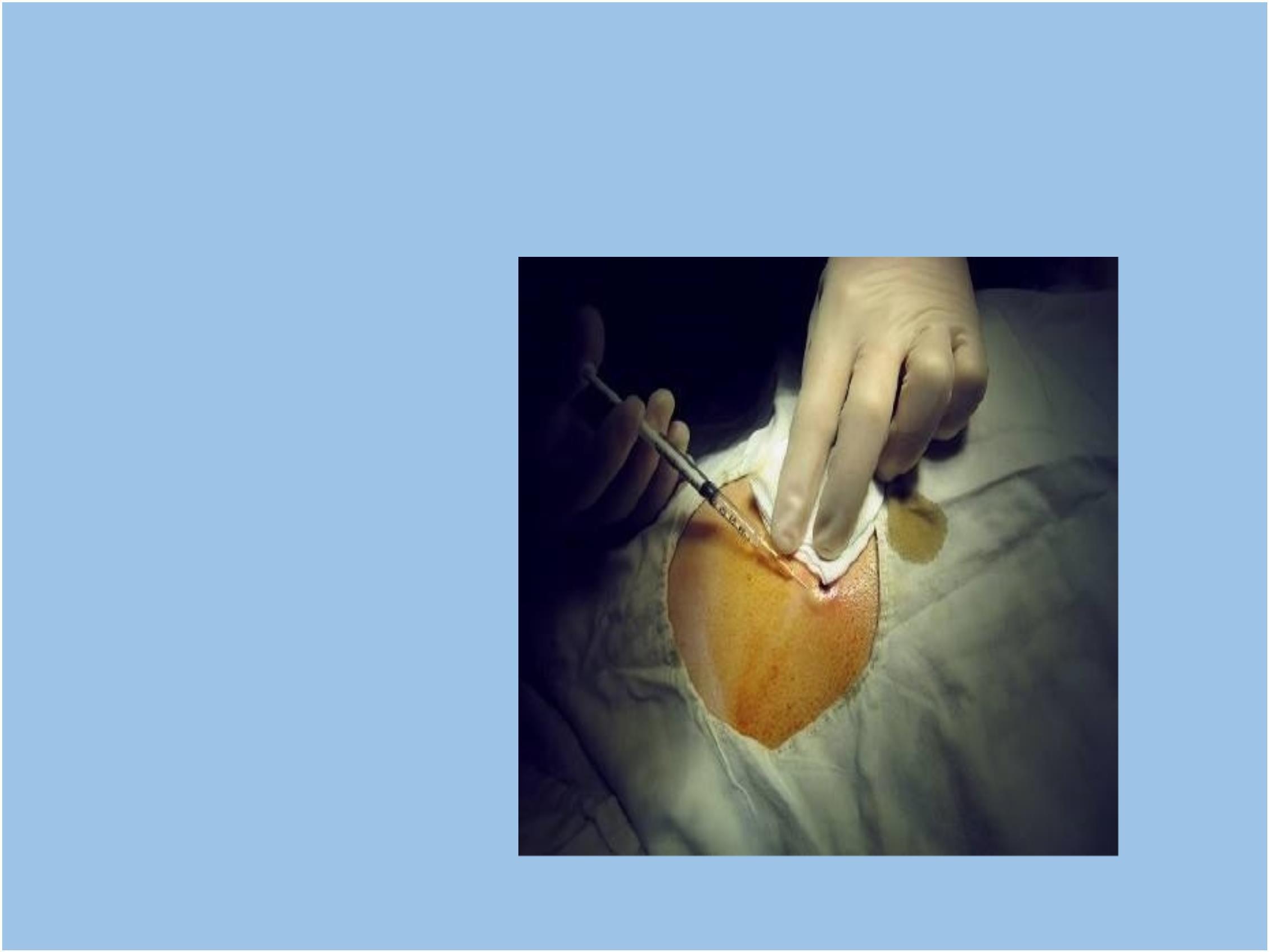 乳头溢液，乳管内的微小病变和乳管镜检查 - 微医（挂号网）