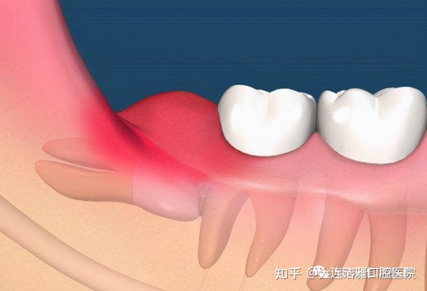 比牙疼还折磨人的智齿冠周炎，到底是何方妖孽？ - 知乎