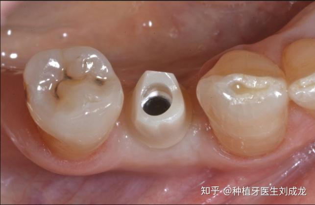 郑州瑞士iti亲水种植牙是怎样的体验主任医师或副主任医师做种植牙是
