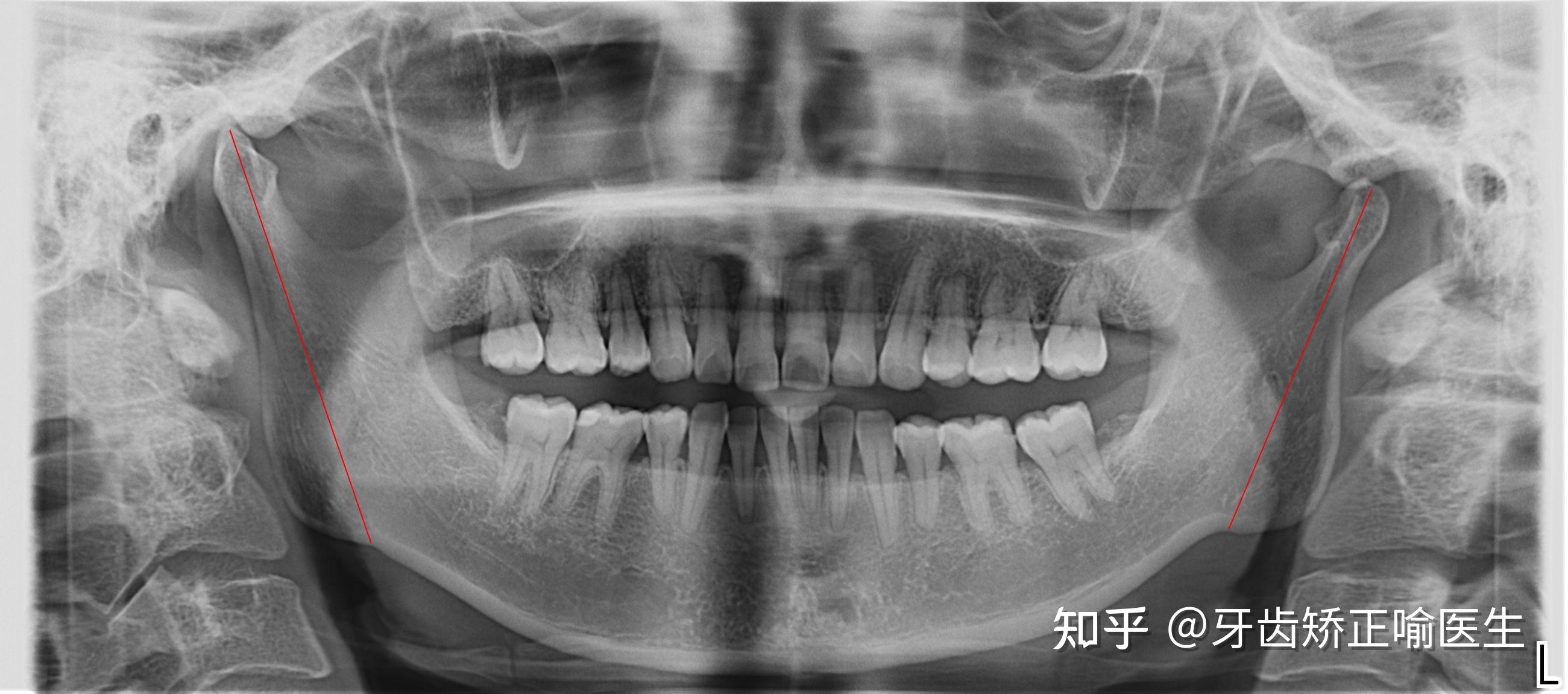单纯正畸改善正颌案例：骨性II类高角上颌前突下颌后缩 - 知乎