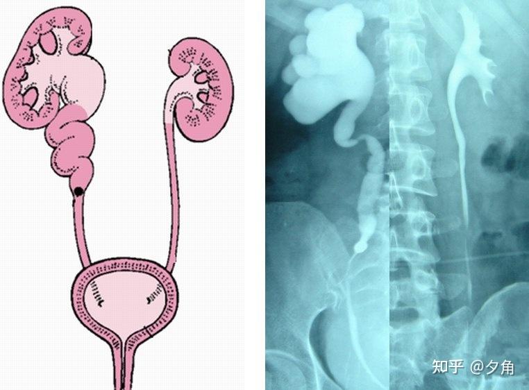 孕检肾积水宝宝该怎么观察