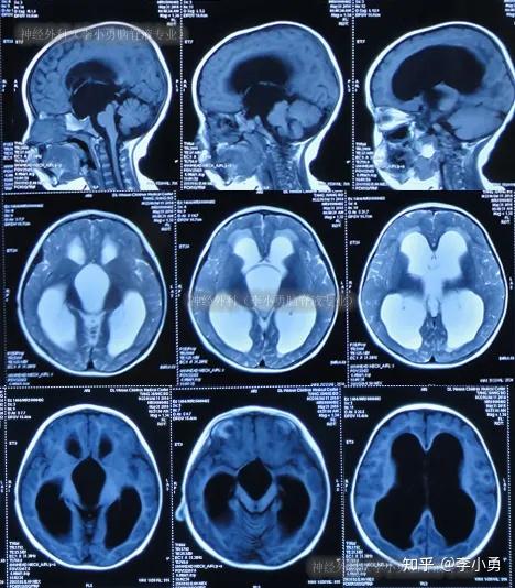 2岁患儿鞍上巨大囊肿致三脑室和侧脑室均进行性加重扩大一周