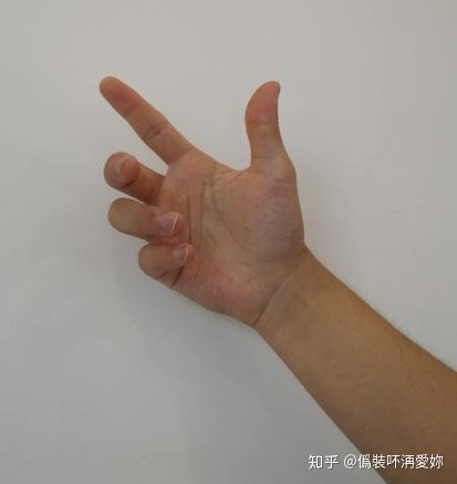 周围神经损伤,康复治疗手段多! - 知乎