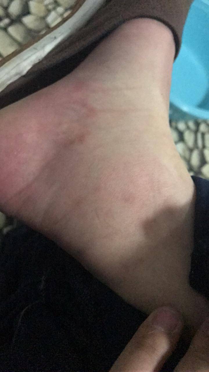 请大家看看我这是痛风吗大脚趾头不疼但脚踝内侧肿了而且静至不疼一