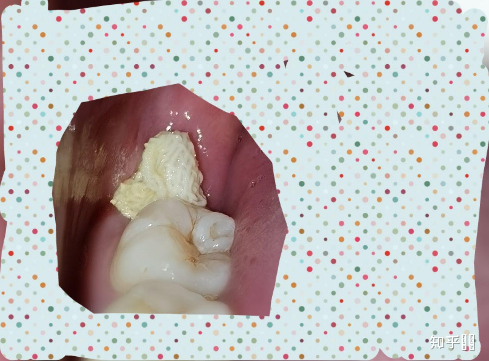拔除智齿后患上干槽症,是种怎样的体验? - 知乎