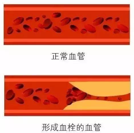 一个动作10秒钟清理血管