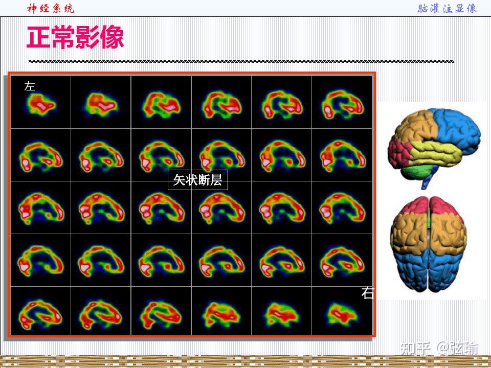 脑灌注成像颜色解读图片