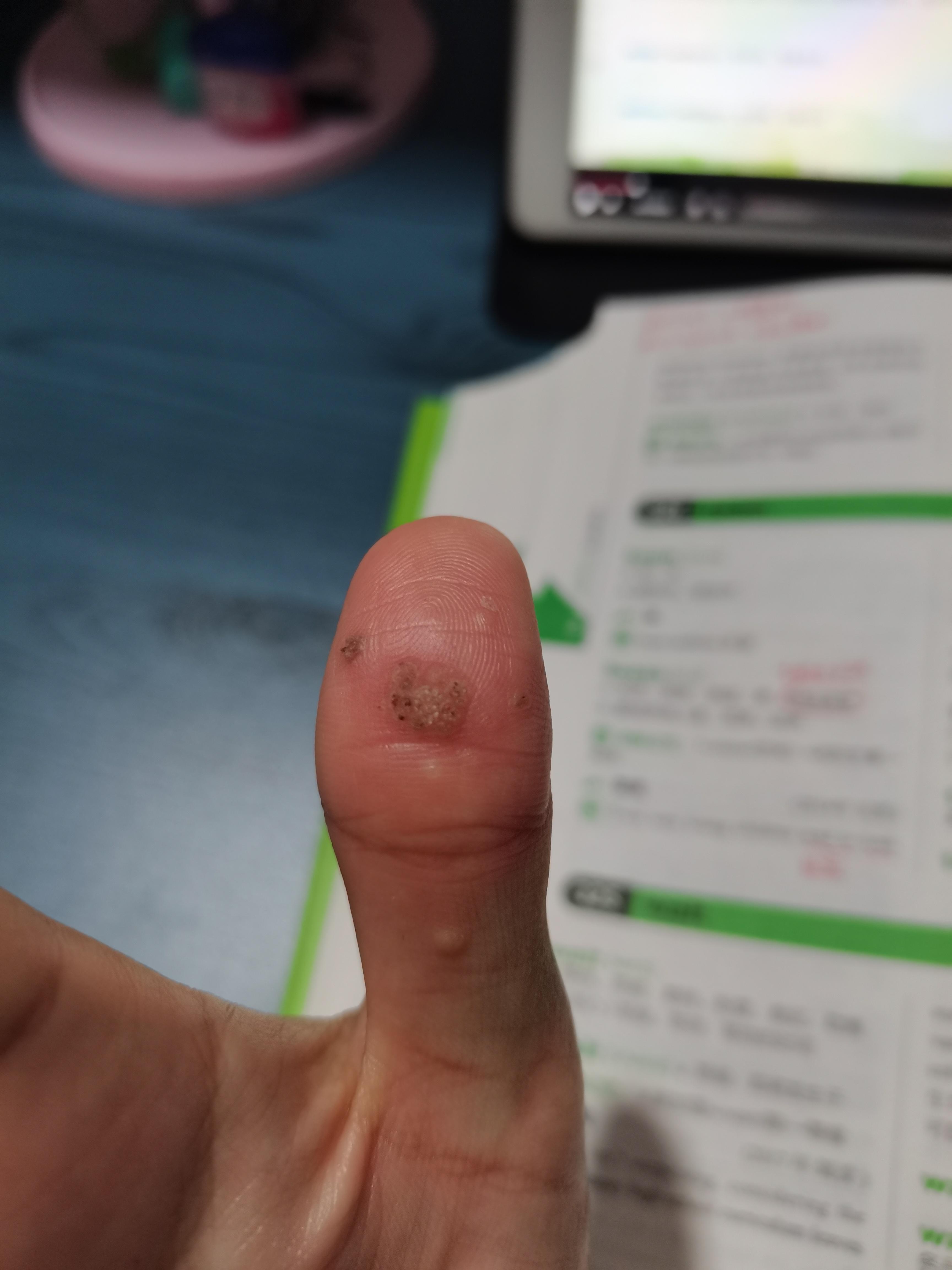 寻常疣会自己痊愈吗