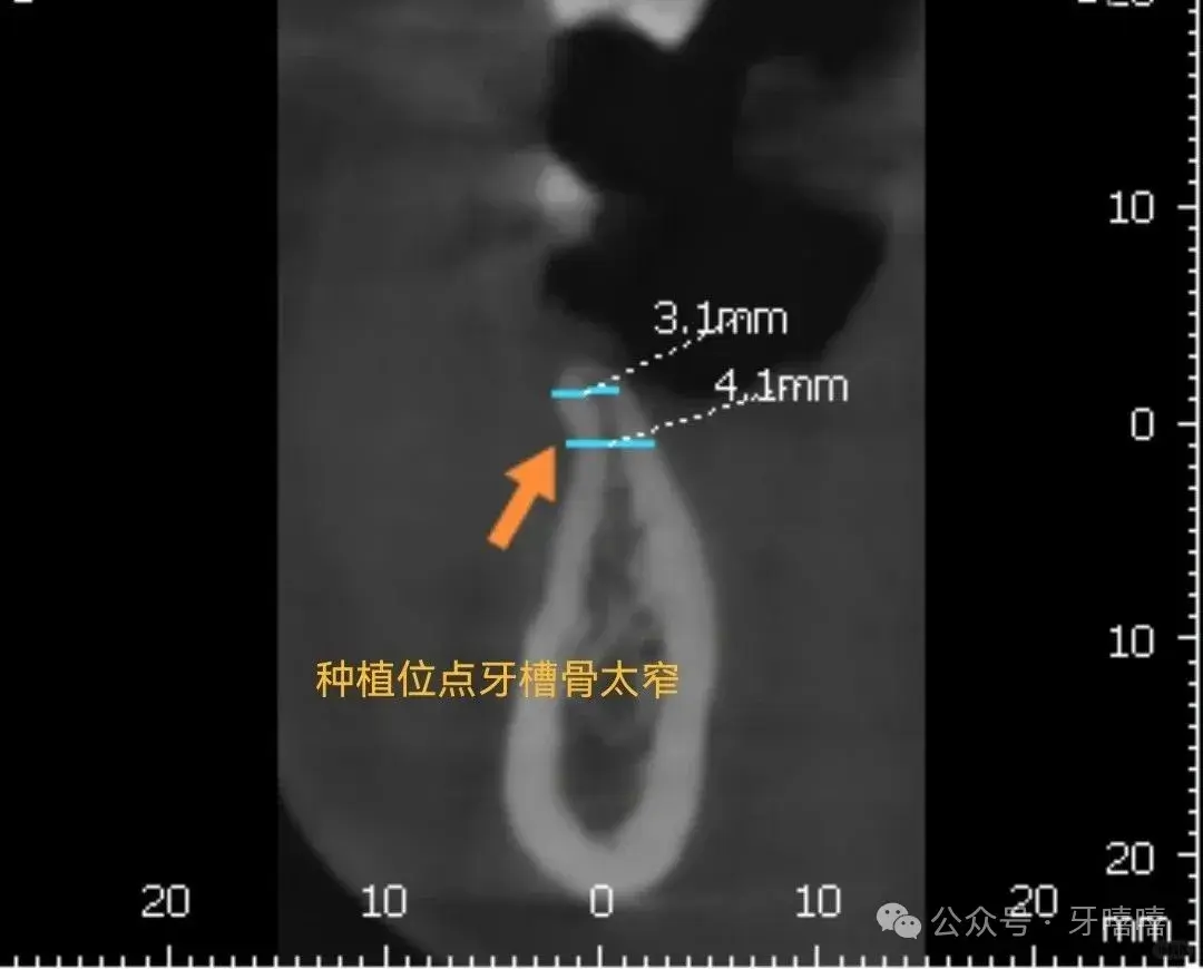 骨增量手术其实是种牙路上最可怕的隐藏关卡 - 知乎