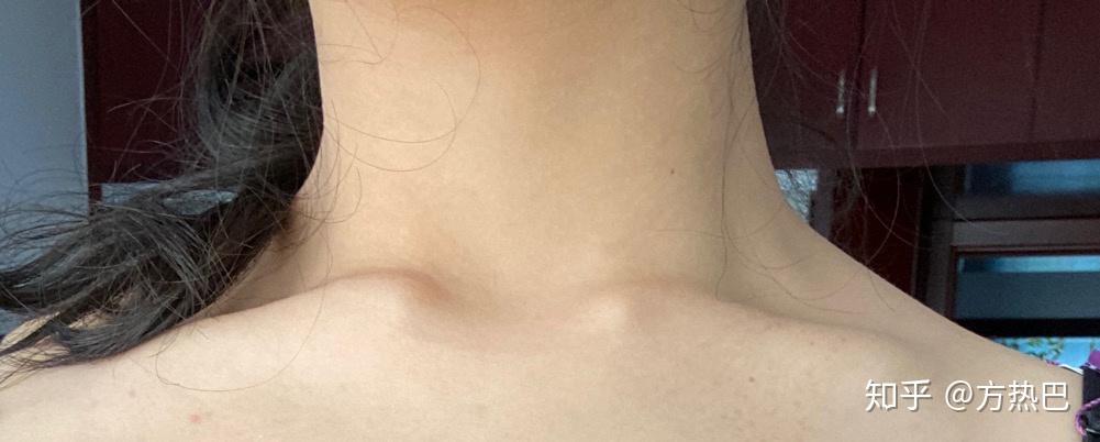 人的锁骨形状分类有几种