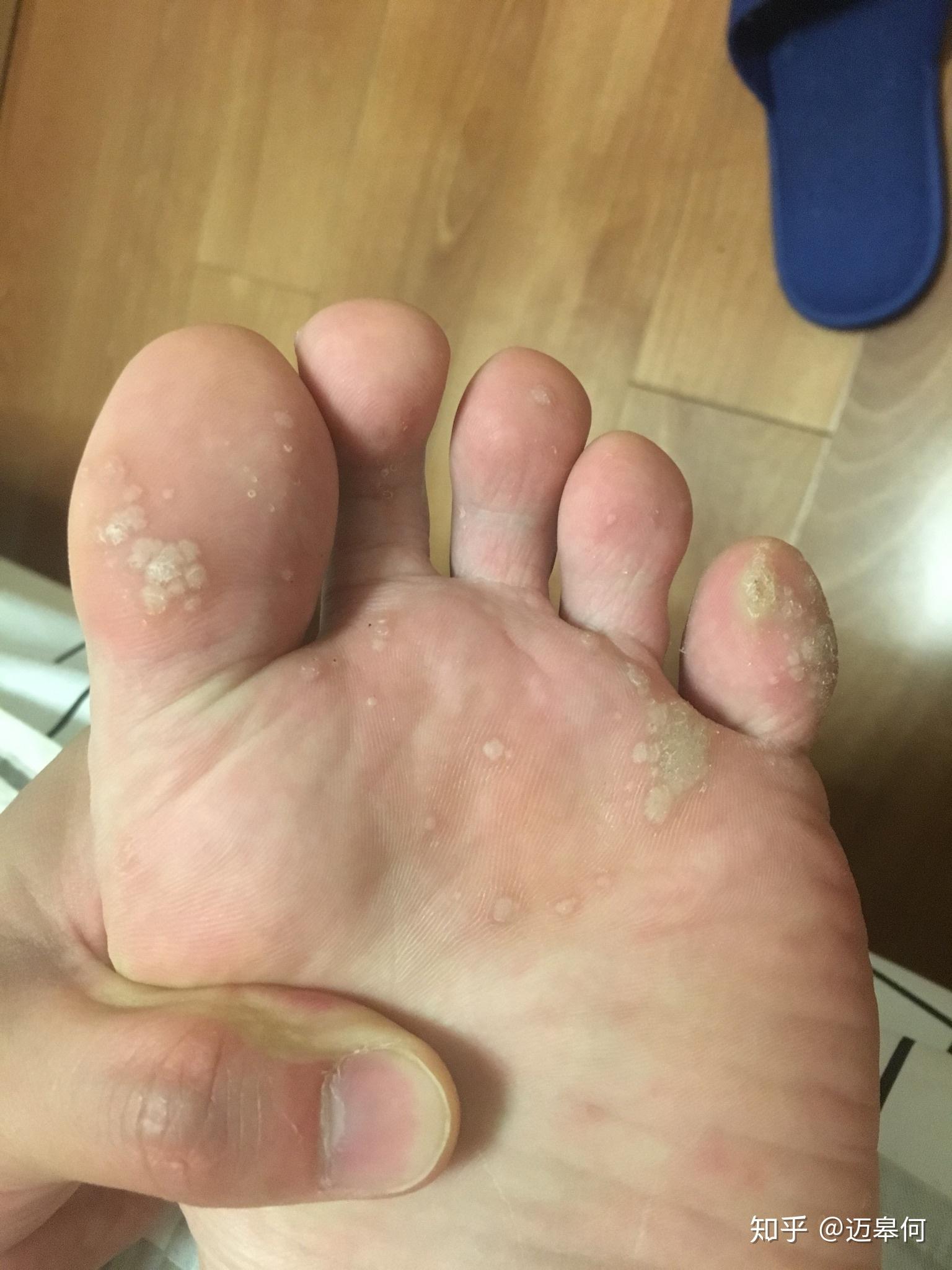 脚底长跖疣怎么办? - 知乎