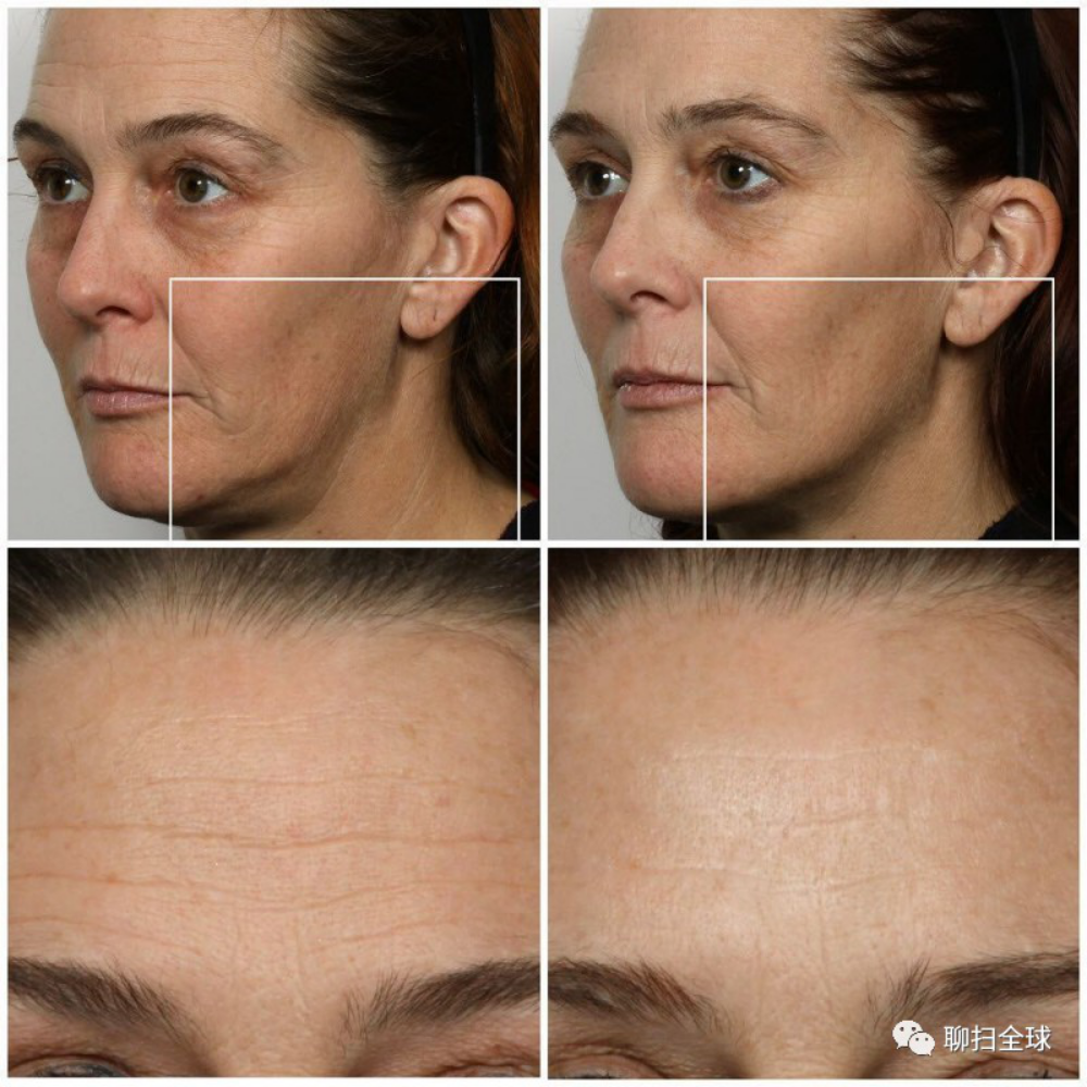 从小孩到成年再到老年,我们脸上的骨骼不会有变化,但是在地心引力和