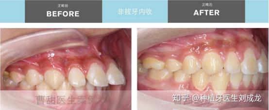 矯治效果:29個月的時間,矯正結束後,軟組織及側貌改善,前突的上前牙