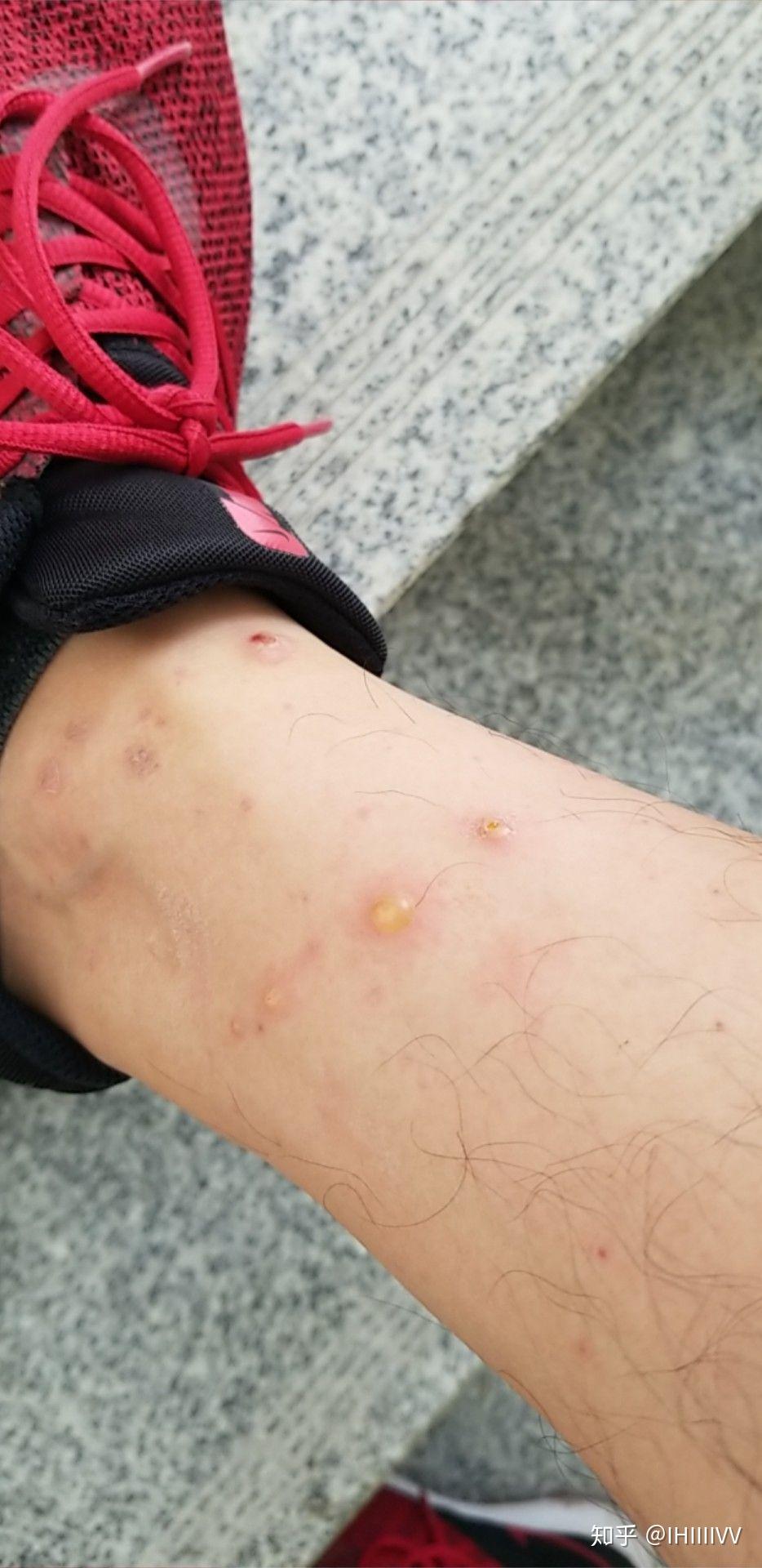 为什么被虫子咬的包会起水泡