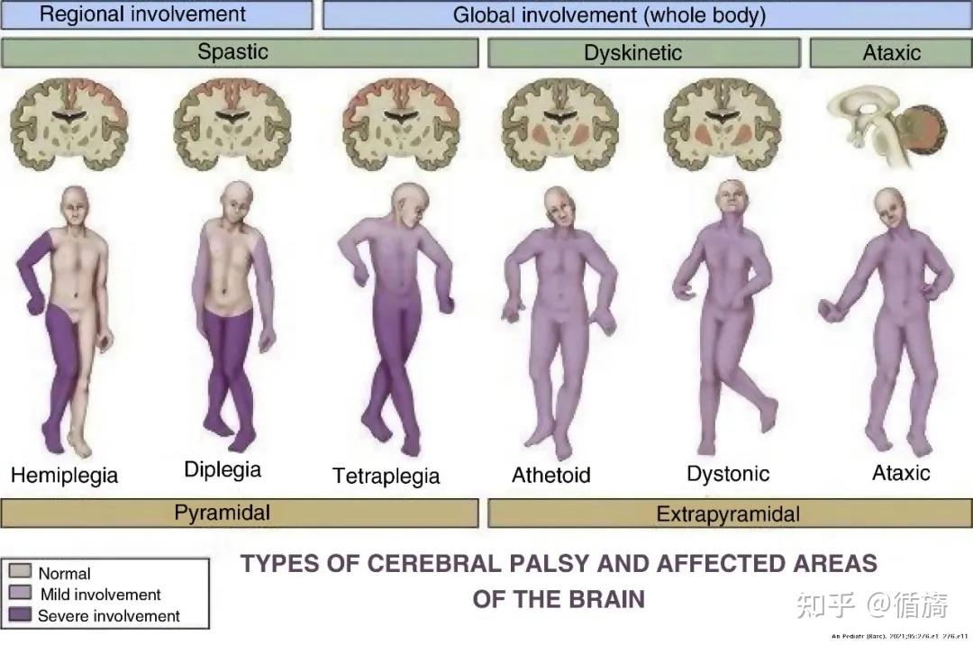 脑瘫是什么原因引起的图片