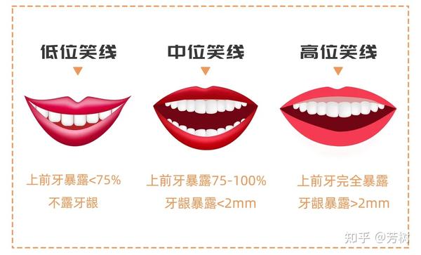 让一众明星笑起来这么美的“微笑线”究竟是什么？ - 知乎