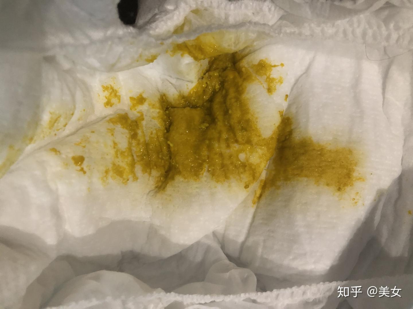 三个月大宝宝的大便这样算拉稀吗 - 知乎