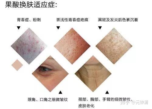 粉刺清 v2-6ffa973dd9fd72df96ec2ba57bc0f960_r.jpg