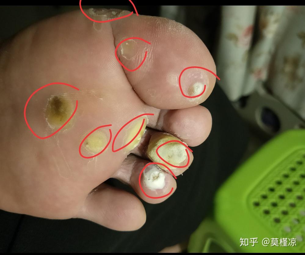 关于怎么治好自己莫名其妙得的跖疣