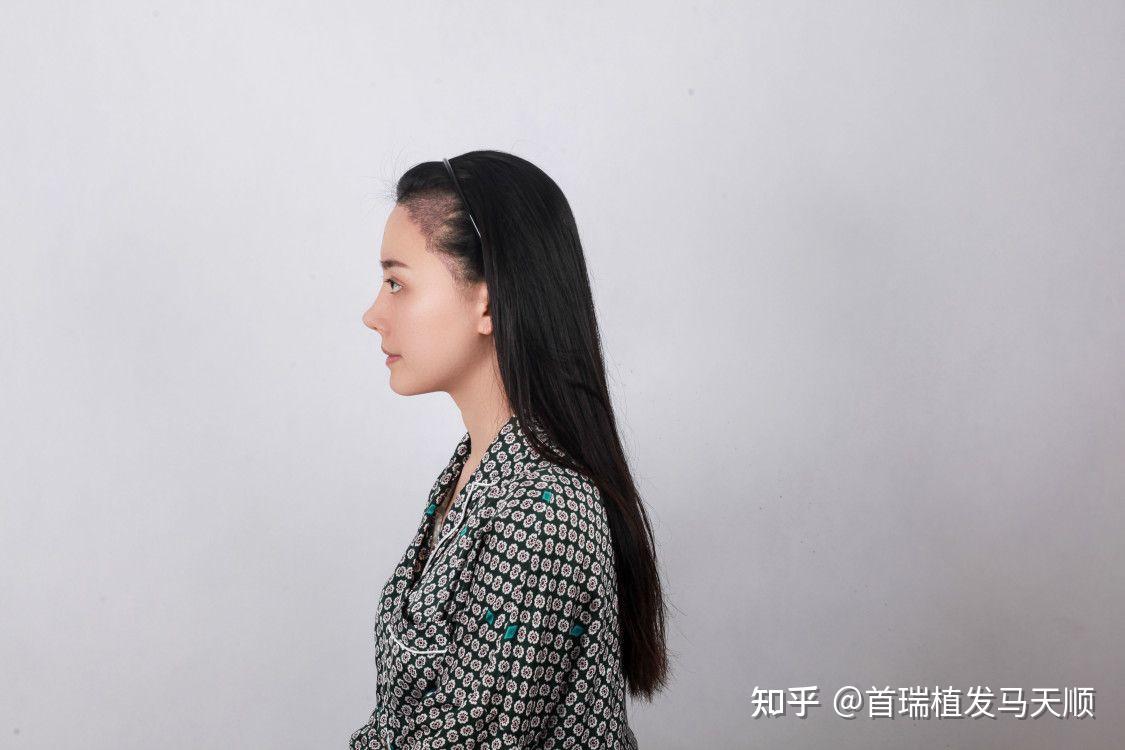 女生m型发际线且高还有救吗